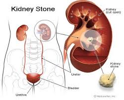 kidney cancer