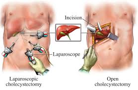 Open gallbladder
