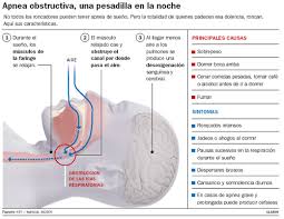 info50 RONQUIDO SIMPLE   ¿Que es?