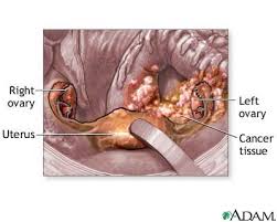Ovarian cancer