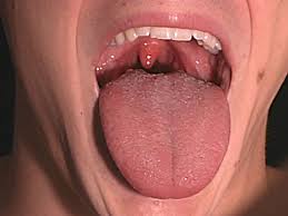 pictures cavity