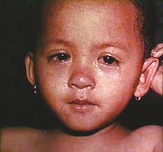 Mumps and Measles