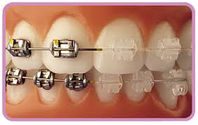 dientes Ortodóncia, prevención, diagnóstico y tratamiento de las anomalías