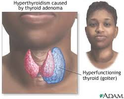 Hyperthyroidism and Natural Solutions