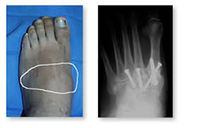 (Lisfranc) Injury