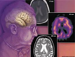 Dementia Is Reversible