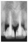 External <b>root resorption</b> after