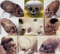 Personas Deformes Reales