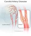 Peripheral Vascular Disease (Peripheral Artery Disease) Causes ...