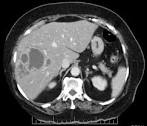 Types of <b>Liver abscess</b>: