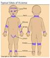 People with <b>eczema</b> have a