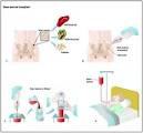 Surgery.com - Bone Marrow Transplantation Information, Surgery ...