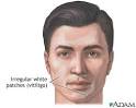 Researchers Find Genetic Connection Between Vitiligo, Thyroid ...