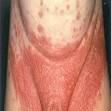  Male Yeast Infection Treatment - Best Treatments for Both Male ... 