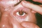 <b>reiter's syndrome</b> 4076 - RightDiagnosis.