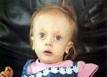 Trisomy 18