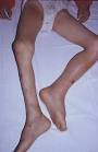 HIV/AIDS Dermatological Images - VA National HIV/AIDS Website