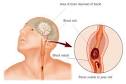 Anoxia | Chicago Personal Injury Law Blog - Passen Law Group - Top ...