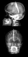 <b>Penetrating head injury</b> in