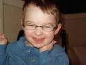 Angelman Syndrome