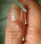 Ganglion Cysts