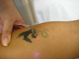Laser Ink Removal For Tattoos