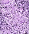 File:CD <b>Granuloma</b>.jpg