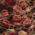 Blood Transfusions Are Associated with Increased Risk of Blood ...