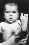 Danielle Barron reports on the battle of survivors of thalidomide to get ... - Thalidomide_Baby