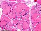 Inclusion body myositis, H&amp;E stain x200