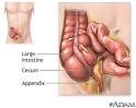 Appendectomy - series: MedlinePlus Medical Encyclopedia