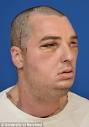 Richard Lee Norris face transplant: Gun accident victim given ...
