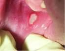 Pictures of Canker Sores - Pictures of Cold Sores