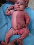 and <b>congenital</b> dislocation