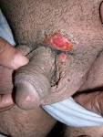<b>Granuloma Inguinale</b>
