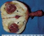 Metastatic <b>rhabdomyosarcoma</b> in