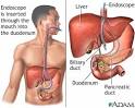 Endoscopic Bile Duct Stone Removal Abroad: Affordable Gall Stone ...