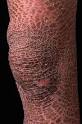 <b>Ichthyosis</b> vulgaris IV is a