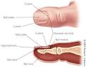 Treating <b>Onychomycosis</b>