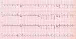 Sinus <b>tachycardia</b>: