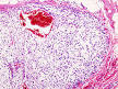 230px-Chondrosarcoma_(1).jpg
