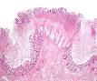 Clostridium difficile - Wikipedia, the free encyclopedia