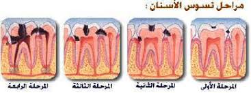 عدم تنظيف الاسنان قد يؤدى الى الموت  Images?q=tbn:ANd9GcQ7teUyUKsRkixV2Bqw8PAVqaG-p4f0ME7dqRzA4JVtPAtFWOmG&t=1