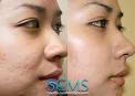 Laser Acne Scar Removal Results after 1 treatment - 10399638-laser-acne-scar-removal-results-after-1-treatment