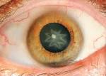 Stellate <b>Cataract</b>