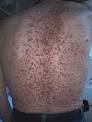 Subtypes of <b>Neurofibroma</b> [edit