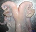 <b>Kyste</b> sur <b>l</b>'<b>ovaire</b> gauche