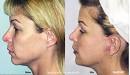 Dr. Pamela Rosen performs the S-Lift, a mini-facelift, for patients in ... - s_lift1