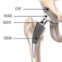 Total <b>Hip Replacement</b>