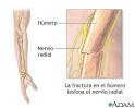 El nervio <b>radial</b> baja por el
